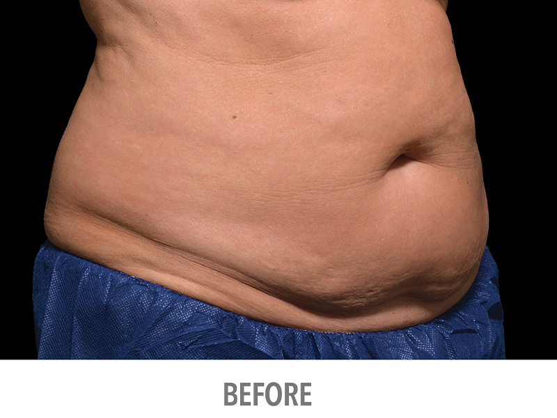 CoolSculpting Stomach Skin Tightening Procedures in Beverly Hills
